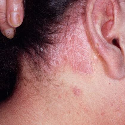 Symptoms And Treatment Of Scalp Psoriasis - How To Treat Scalp ...