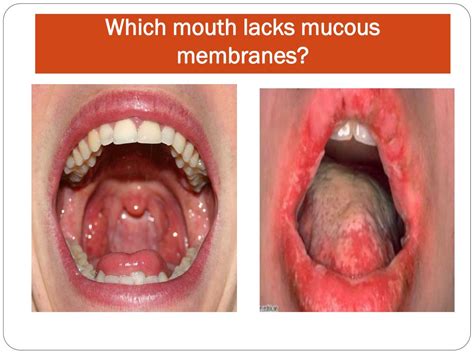 PPT - Mouth Care Session For HCSWs in Practice PowerPoint Presentation ...