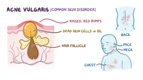 Medications for acne vulgaris: Nursing pharmacology - Osmosis Video Library