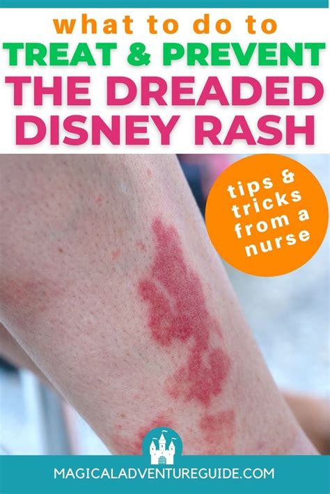 The Disney Rash: A Nurse's Tips for Preventing and Treating It ...