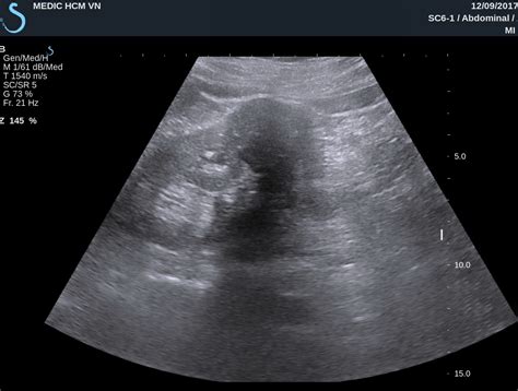 VIETNAMESE MEDIC ULTRASOUND: CASE 457: AML KIDNEY TUMOR, Dr PHAN THANH ...