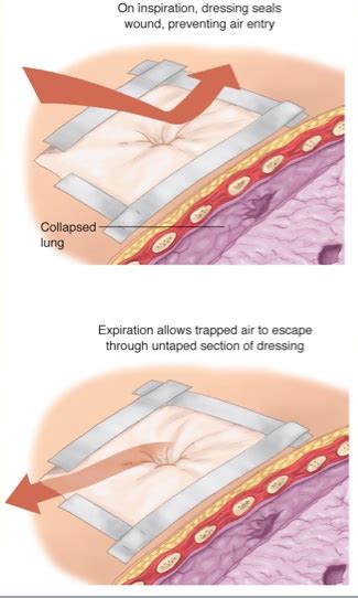 Kesehatan dan Keperawatan: OPEN PNEUMOTHORAX