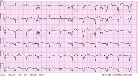 AIVR ECG | LearntheHeart.com