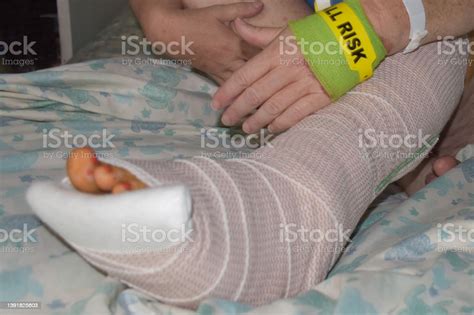 Fractured Ankle In Cast After Lateral Malleolus Orif Surgery Stock ...