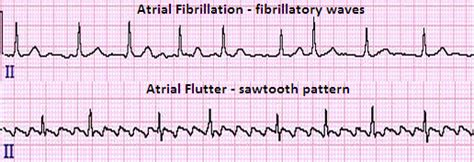 Atrial Fibrillation And Flutter