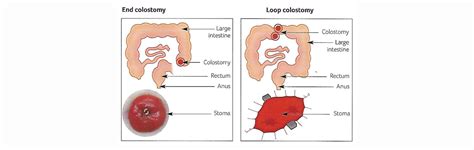 | Colostomy