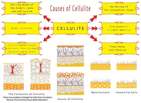 What Causes Cellulite? Find out Why You Have Cellulite!