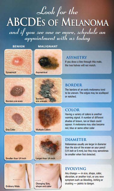 ABCDE's of Melanoma - Jupiter Dermatology & Hair Restoration