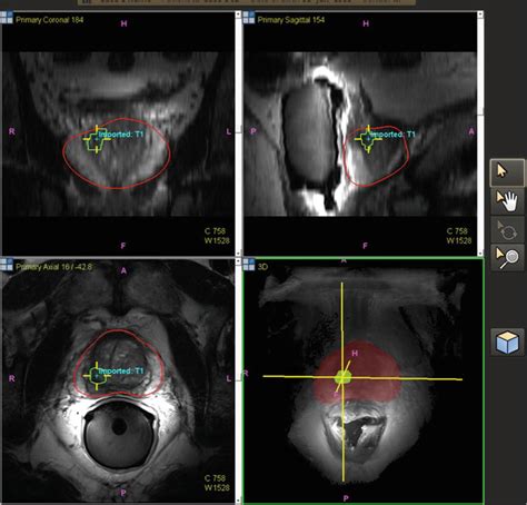 Prostate Mri Fusion Biopsy Procedure