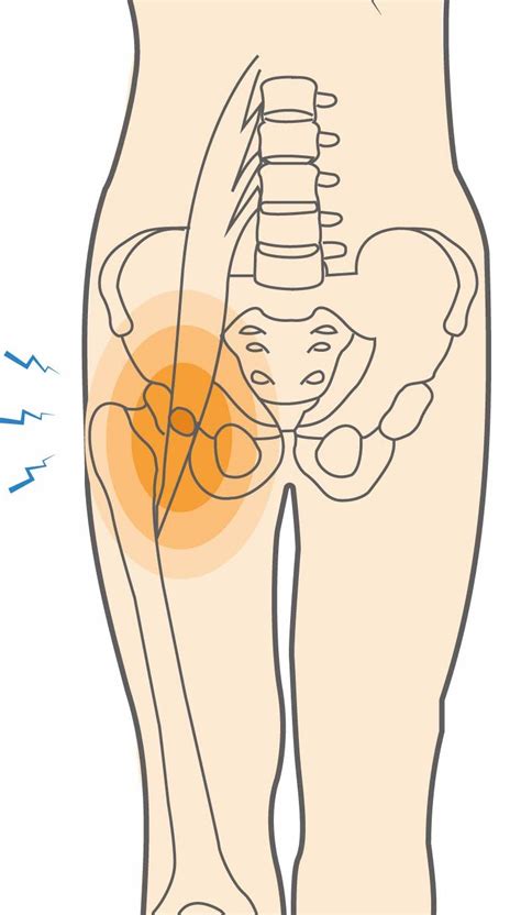 Iliopsoas Tendon