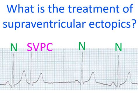 Ectopic Supraventricular Rhythm Store | vivatumusica.com