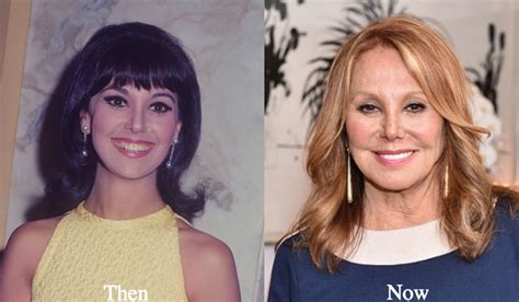 Marlo Thomas Plastic Surgery Before and After Photos - Latest Plastic ...