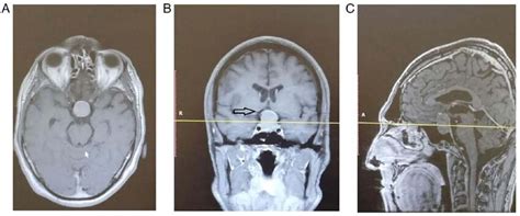 (A-C) Pre-operative contrast enhanced T1 MRI scan of patient 2 ...