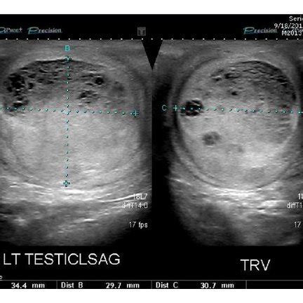 Scrotal ultrasound of left testis (sagittal and transverse views). Note ...