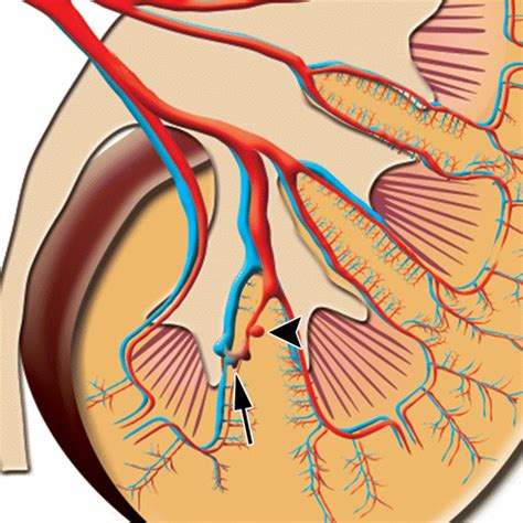 Renal Arteriovenous Shunts: Clinical Features, Imaging Appearance, and ...