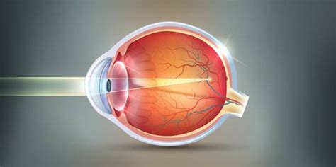 Surgical Treatment of High Myopia | DLV Vision