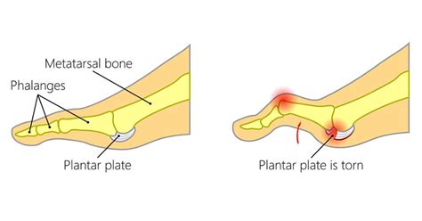 Podiatry Centre for Plantar Plate Tear in Singapore