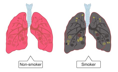 Lungs clipart lung smoker, Lungs lung smoker Transparent FREE for ...