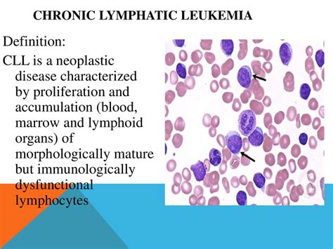 Pathophysiology Of Acute Lymphocytic Leukemia