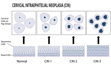 Abnormal Pap Smear Tests: Causes, Symptoms, & Treatment