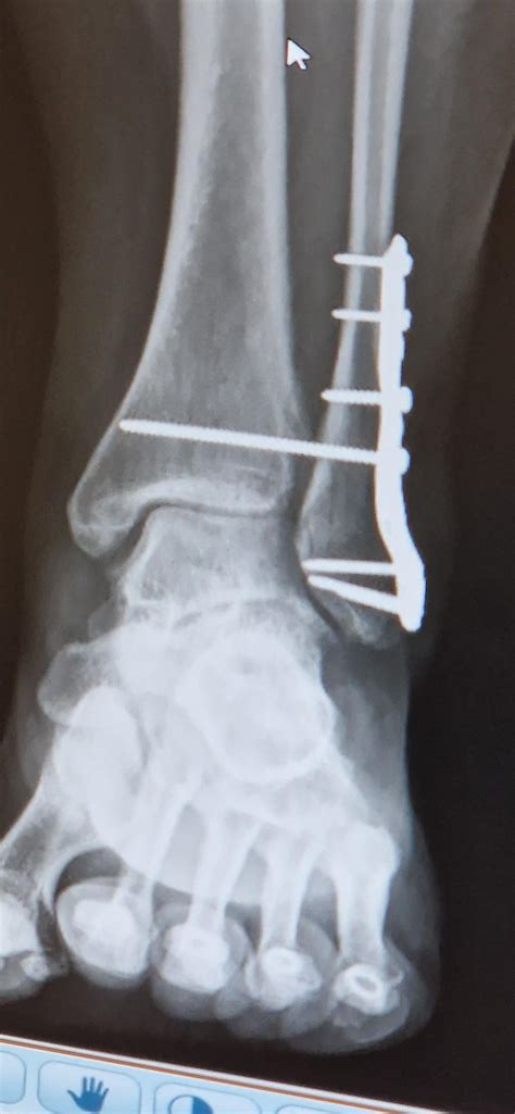 X-ray of my left ankle ORIF for (iirc) a distal fibula and posterior ...