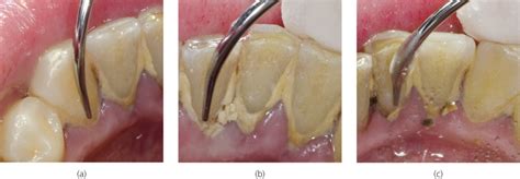 8: Case studies in ultrasonic debridement | Pocket Dentistry