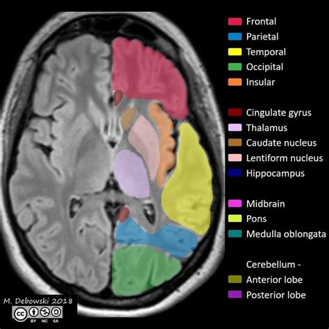 Brain Anatomy On Mri | Free Nude Porn Photos