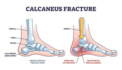 Calcaneus Fracture: Symptoms & Treatment by a Foot Specialist