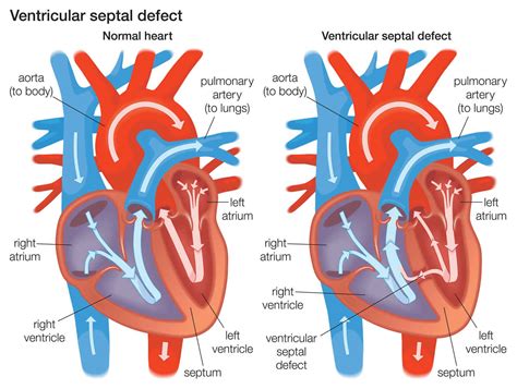 Ventricular septal defect causes, types, symptoms, diagnosis, treatment ...