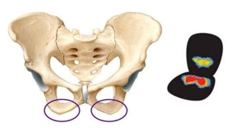 Ischial Tuberosity Syndrome Pain, Pictures, Treatment