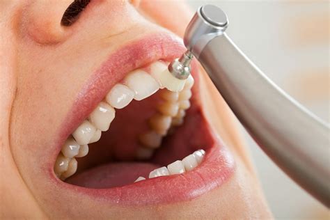 How Long Should a Dental Cleaning Take | Dental Checkup