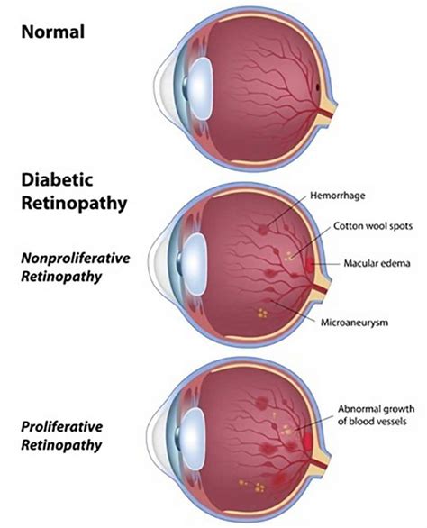 Diabetic Retinopathy; Symptoms, Causes, Complications & Treatment