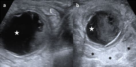 Enteric duplication cysts in children: varied presentations, varied ...