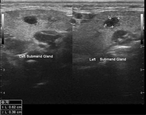 Heterogeneous Submandibular Gland Ultrasound