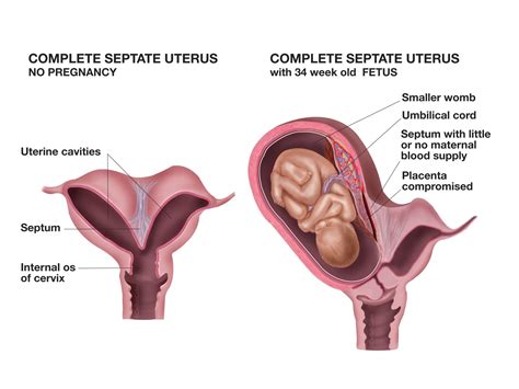 What is a Septate Uterus? - Torontek