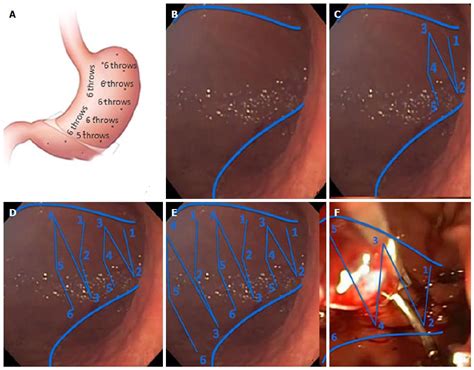 Current applications of endoscopic suturing