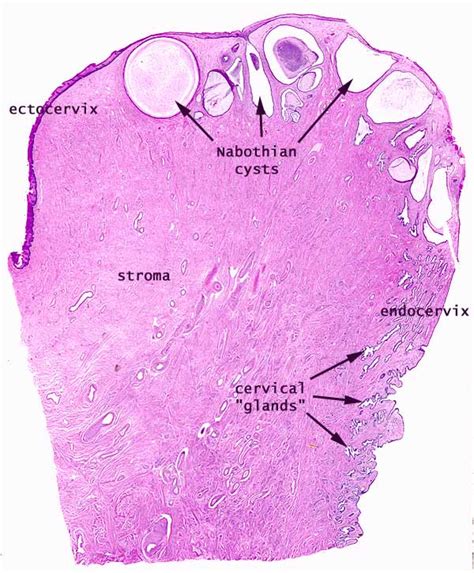 Pathology Outlines - Nabothian cysts