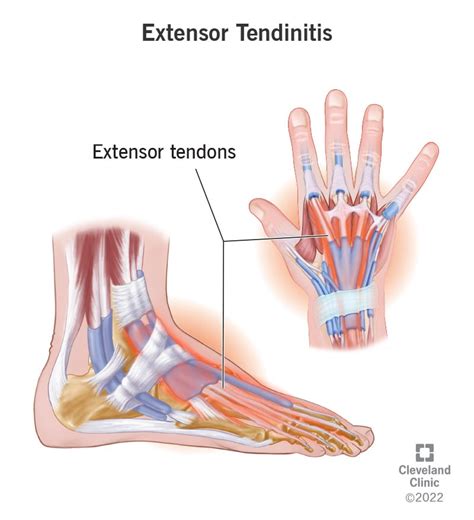 Extensor Tendonitis: What It Is, Causes & Treatment