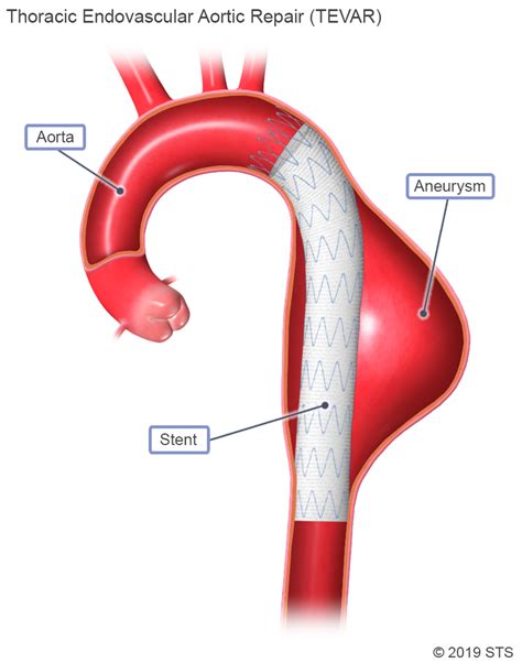 Thoracic Aortic Aneurysm - Newport Cardiac & Thoracic Surgery