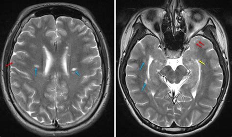 Dawson fingers (multiple sclerosis) – Radiology Cases