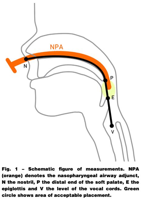 Nose-to-Tragus or Not - What Depth for Nasopharyngeal Airway in ...