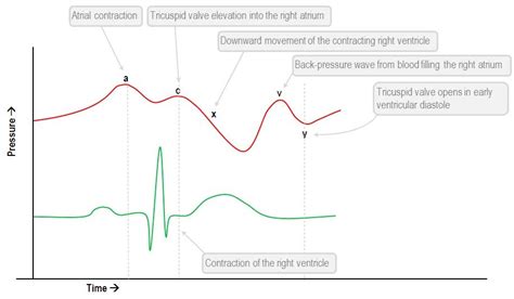 The V Wave Of An Atrial Pressure Tracing Corresponds To - Shajara