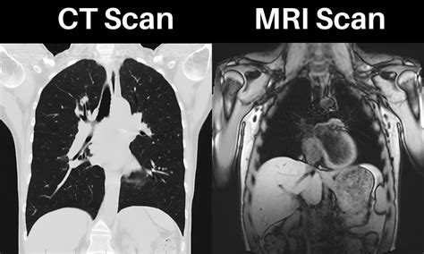 Ppt Difference Between Ct Scan Mri Scan Powerpoint Presentation | Hot ...