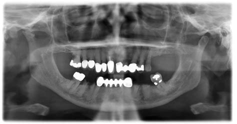 Mandibular Foramen Radiograph