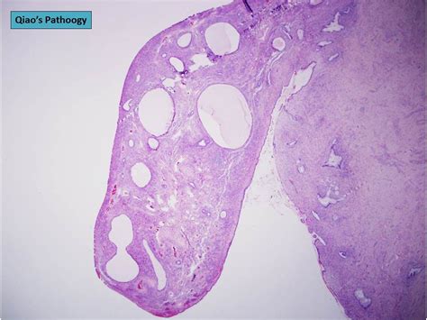 Qiao's Pathology: Mixed Endometrial-Endocervical type of Cervical Polyp ...