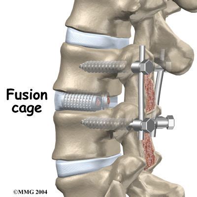 lumbar fusion with cage and pedicle screws | Spine surgery, Spinal ...