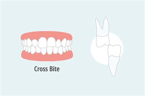 What is Crossbite Teeth? - Brite Orthodontics