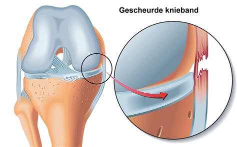 Gescheurde knieband - Slingeland Ziekenhuis