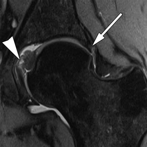 MRI of Labral and Chondral Lesions of the Hip | AJR