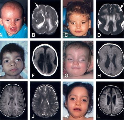 Lissencephaly Diagram | Quizlet